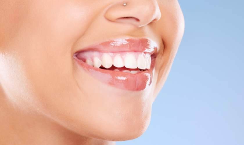Teeth Whitening-North Court Family Dentistry Circleville